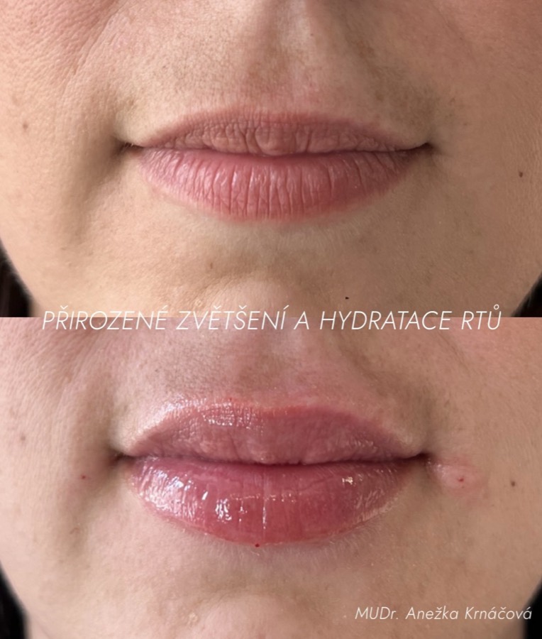Zvětšení a hydratace rtů — výsledek před a po
