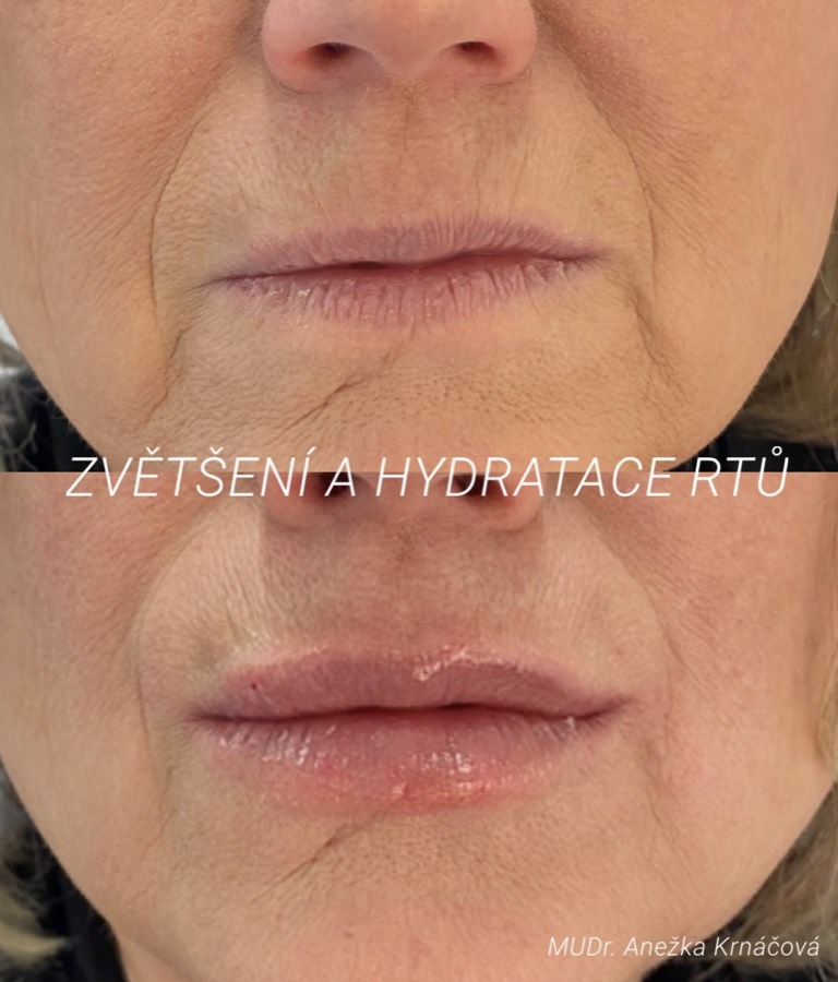 Přirozené zvětšení rtů bez efektu kačera — před a po