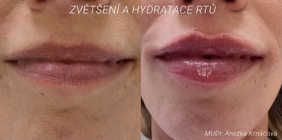 Augmentace rtů kyselinou hyaluronovou — fotografie výsledku