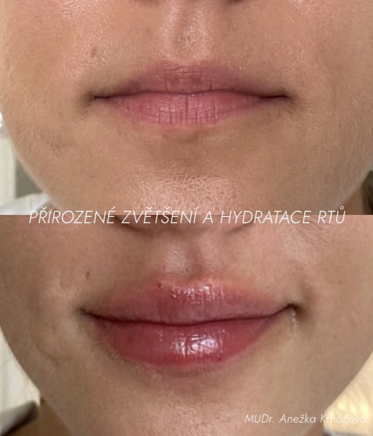 Hydratace a zvětšení rtů kyselinou hyaluronovou — před a po