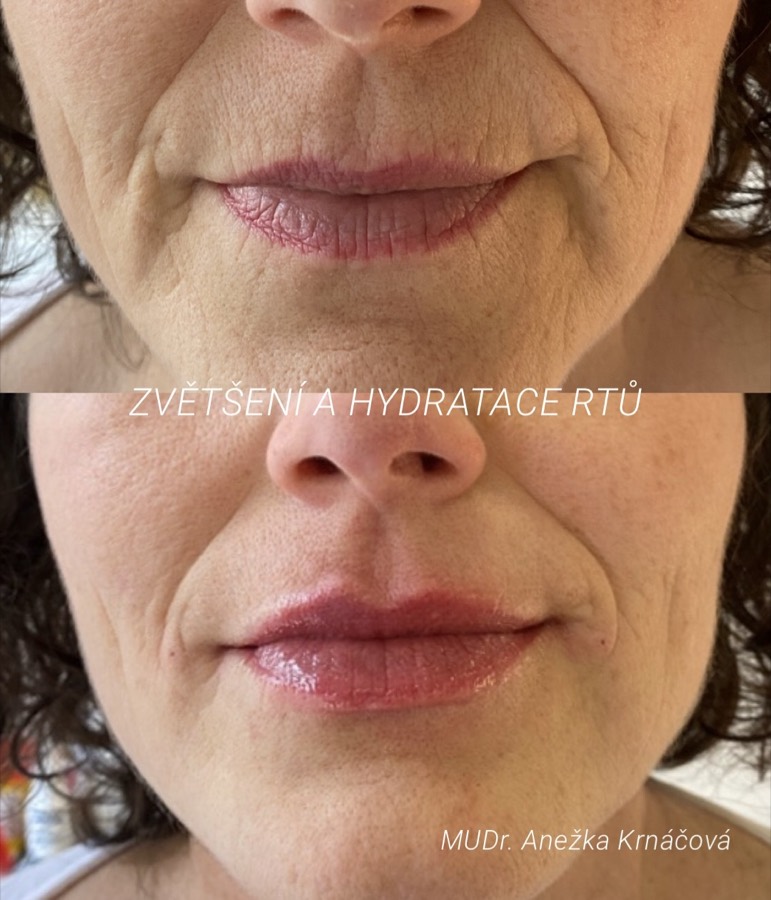 Výplň rtů u dermatoložky — přirozený výsledek před a po